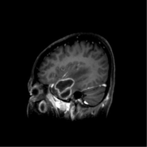 File:Nasopharyngeal carcinoma with cerebral abscess (Radiopaedia 43018-46274 J 18).png