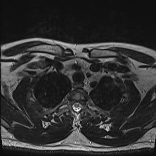 Nasopharyngeal carcinoma with perineural spread (Radiopaedia 55030-61380 Axial T2 87).jpg