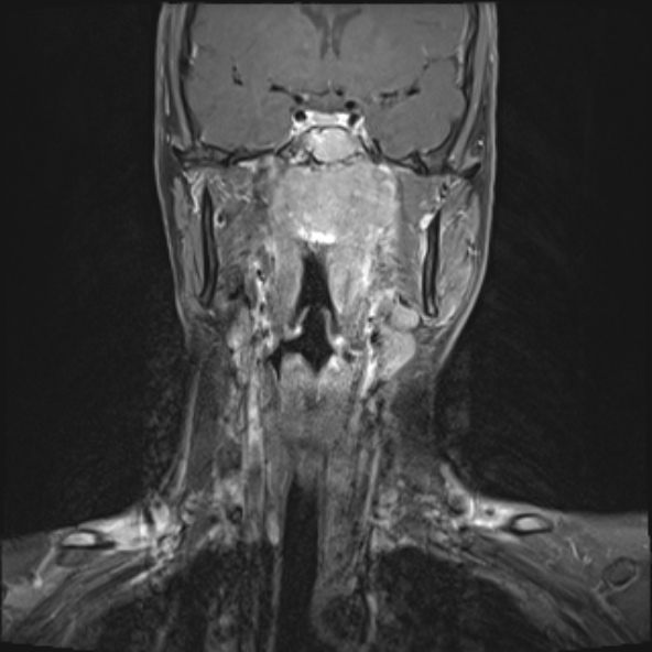 Nasopharyngeal carcinoma with skull base invasion (Radiopaedia 53415-59485 E 20).jpg