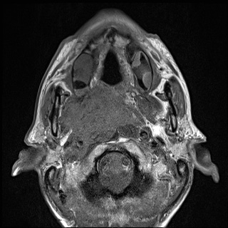 Nasopharyngeal carcinoma with skull base invasion (Radiopaedia 59258-66600 B 24).jpg