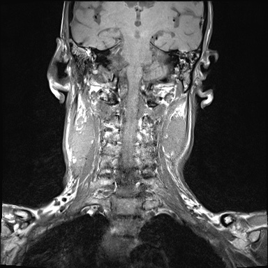 File:Nasopharyngeal carcinoma with skull base invasion (Radiopaedia 59258-66600 Coronal T1 9).jpg