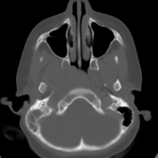 File:Nasopharyngeal rhabdomyosarcoma (Radiopaedia 23417-23491 Axial bone window 7).jpg