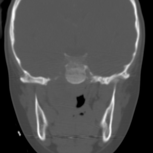 File:Nasopharyngeal rhabdomyosarcoma (Radiopaedia 23417-23491 Coronal bone window 1).jpg