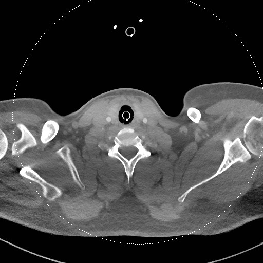 Neck CT angiogram (intraosseous vascular access) (Radiopaedia 55481-61945 B 133).jpg