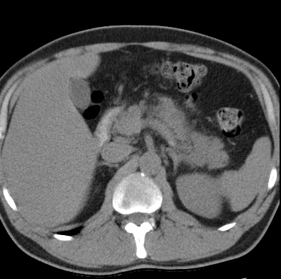 File:Necrotizing pancreatitis with acute necrotic collection (Radiopaedia 14470-14417 Axial non-contrast 11).jpg