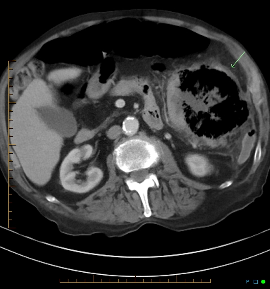 Necrotzing fasciitis due to a perforated adenocarcinoma of the splenic flexure (Radiopaedia 46930-51455 A 31).jpg
