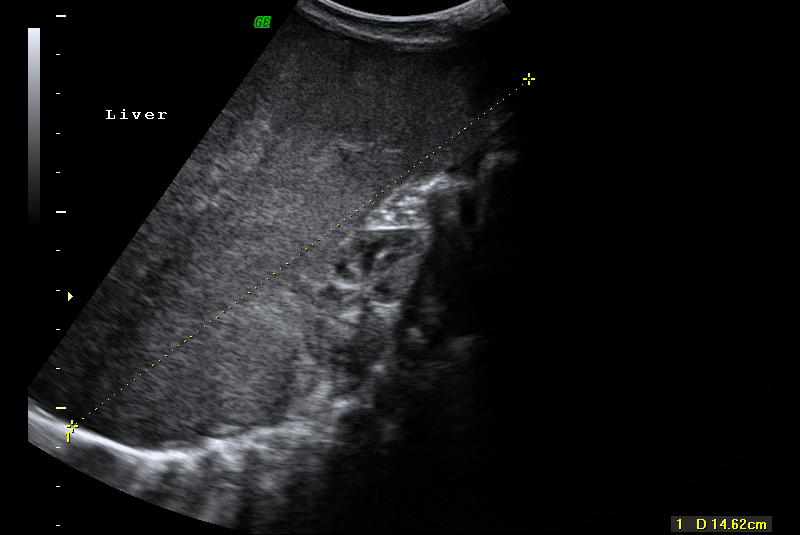 File:Neonatal neuroblastoma (Radiopaedia 9564-10221 A 5).jpg