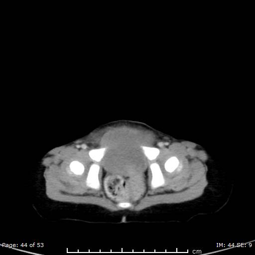 Nephroblastomatosis (Radiopaedia 41934-44935 A 44).jpg