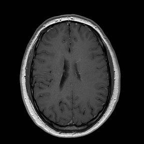 File:Neuro-Behcet's disease (Radiopaedia 21557-21506 Axial T1 C+ 18).jpg