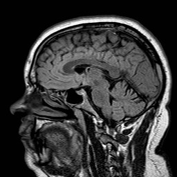File:Neuro-Behcet's disease (Radiopaedia 21557-21506 Sagittal FLAIR 16).jpg