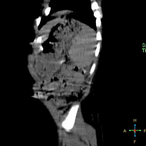 File:Neuroblastoma (Radiopaedia 24751-25016 C 2).jpg