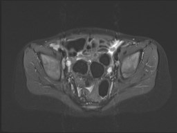 File:Neuroblastoma with bone metastases (Radiopaedia 67080-76414 Axial STIR 52).jpg