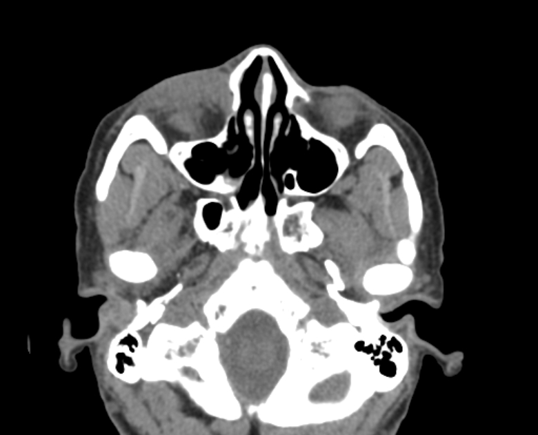 Neurofibromatosis type 1- orbital manifestations (Radiopaedia 49391-54511 Axial non-contrast 35).jpg