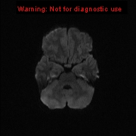 File:Neurofibromatosis type 1 with optic nerve glioma (Radiopaedia 16288-15965 Axial DWI 64).jpg
