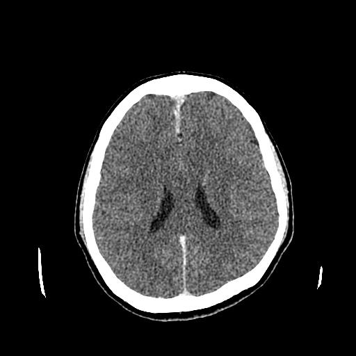 File:Neurofibromatosis type 2 (Radiopaedia 25389-25637 Axial C+ 60).jpg