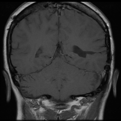 File:Neurofibromatosis type 2 (Radiopaedia 45229-49251 Coronal T1 1).png