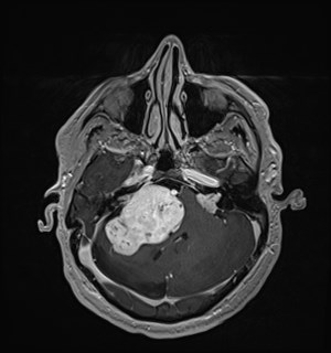Neurofibromatosis type 2 (Radiopaedia 79097-92049 Axial T1 C+ 58).jpg