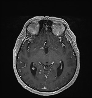 Neurofibromatosis type 2 (Radiopaedia 79097-92049 Axial T1 C+ 93).jpg