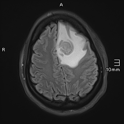 File:Neurotoxoplasmosis - concentric target sign (Radiopaedia 70644-80784 Axial FLAIR 16).jpg