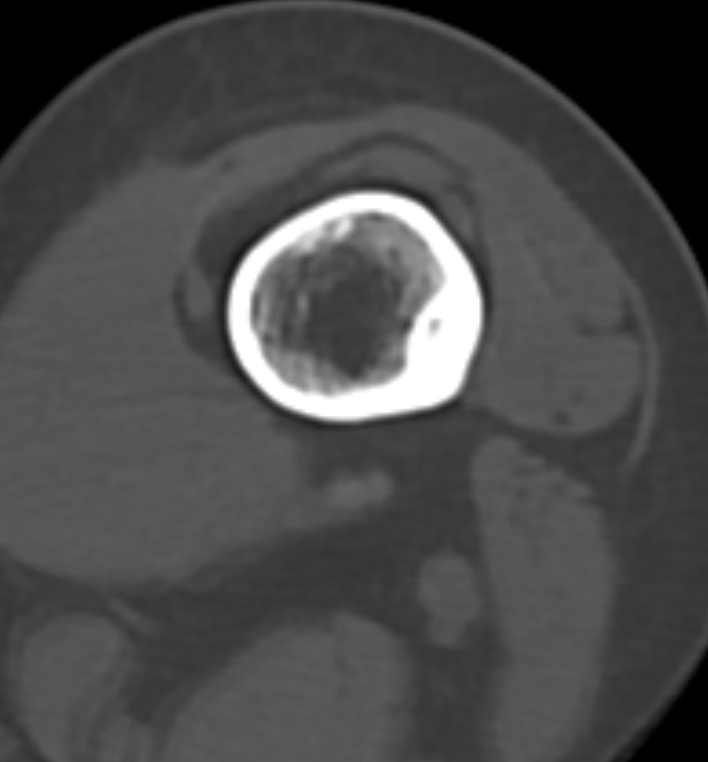 Non-ossifying fibroma - femur (Radiopaedia 82786-97042 Axial bone window 37).jpg
