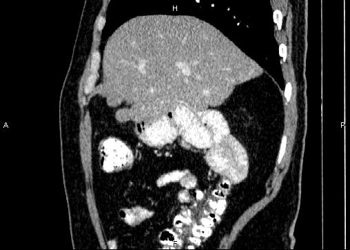 Non-syndromic pancreatic endocrine tumor (Radiopaedia 86958-103178 E 24).jpg