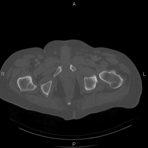 Non Hodgkin lymphoma in a patient with ankylosing spondylitis (Radiopaedia 84323-99624 Axial bone window 67).jpg