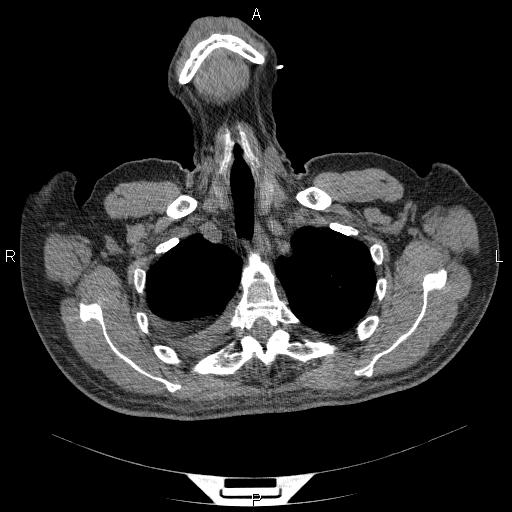 File:Non Hodgkin lymphoma in a patient with ankylosing spondylitis (Radiopaedia 84323-99624 Axial non-contrast 7).jpg