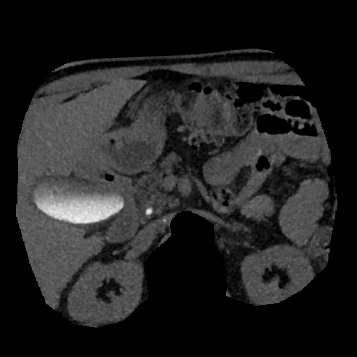 File:Normal CT intravenous cholangiogram (Radiopaedia 38199-40208 Axial IVC (MIP) 34).png