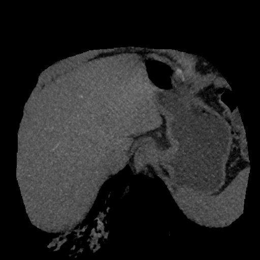File:Normal CT intravenous cholangiogram (Radiopaedia 38199-40208 Axial IVC (MIP) 78).png