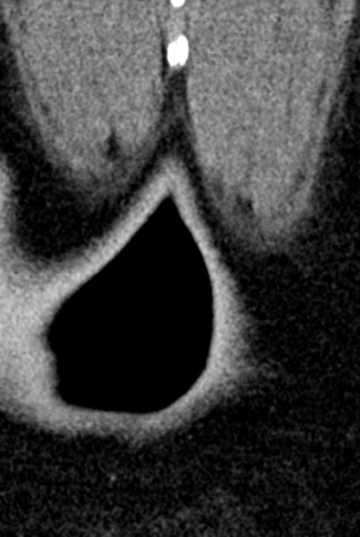 Normal CT lumbar spine (Radiopaedia 53981-60118 F 112).jpg