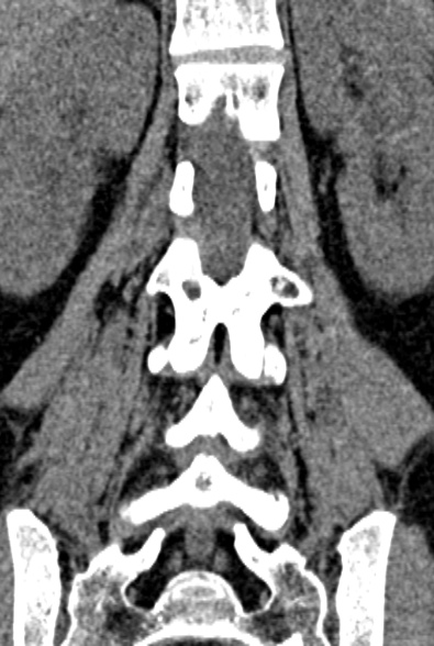 Normal CT lumbar spine (Radiopaedia 53981-60118 F 61).jpg