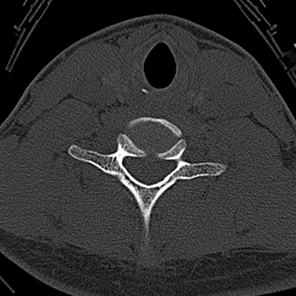 File:Normal CT of the cervical spine (Radiopaedia 53322-59305 Axial bone window 198).jpg