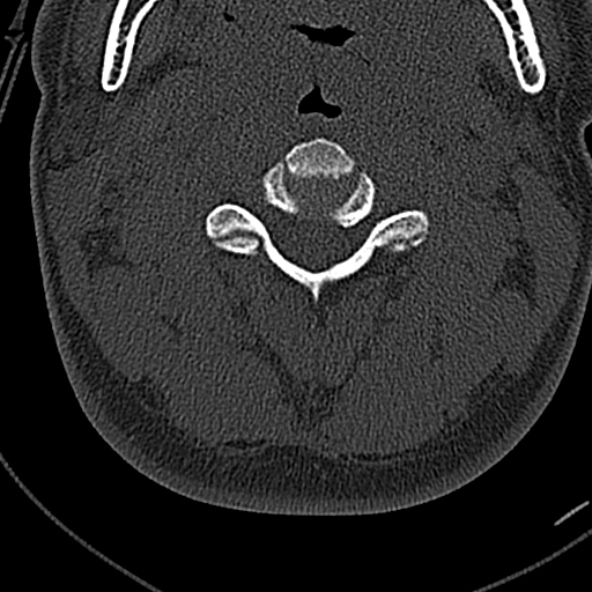 Normal CT of the cervical spine (Radiopaedia 53322-59305 Axial bone window 99).jpg