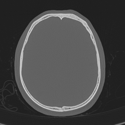 Normal CT skull (Radiopaedia 40798-43459 A 104).png