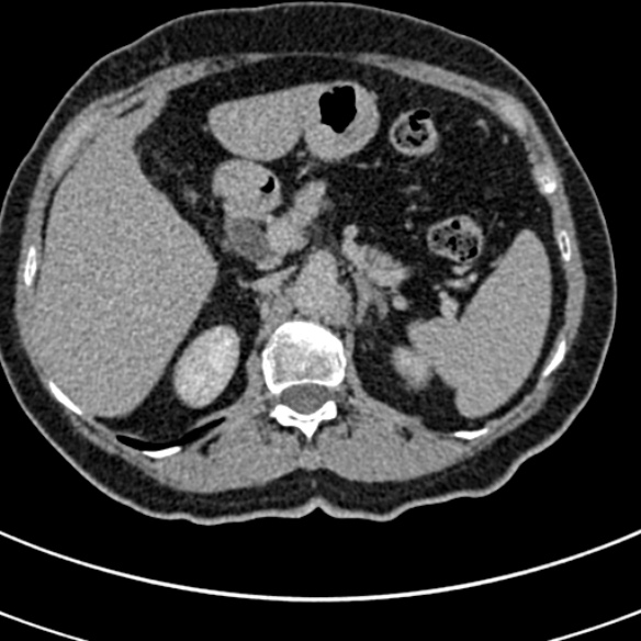 File:Normal CT split bolus study of the renal tract (Radiopaedia 48631-53634 Axial split bolus 29).jpg