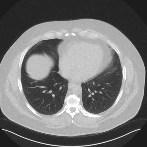 Normal HRCT (Radiopaedia 40797-43458 Axial lung window 39).png