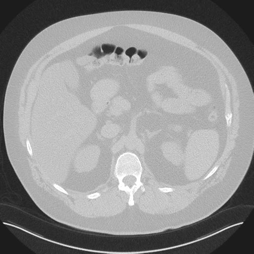 Normal HRCT (Radiopaedia 40797-43458 Axial lung window 64).png