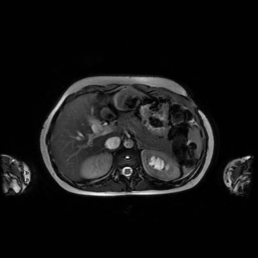 File:Normal MRI abdomen in pregnancy (Radiopaedia 88001-104541 Axial Gradient Echo 13).jpg