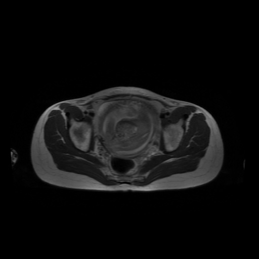 File:Normal MRI abdomen in pregnancy (Radiopaedia 88001-104541 Axial T2 62).jpg