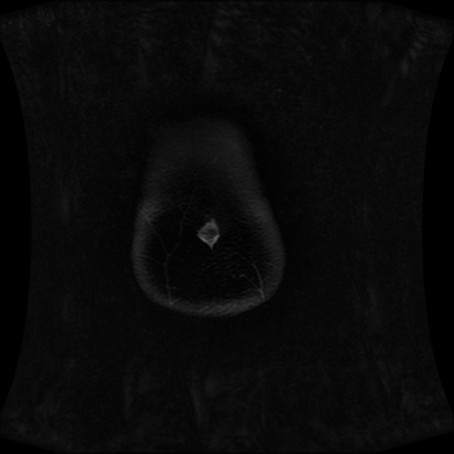 Normal MRI abdomen in pregnancy (Radiopaedia 88001-104541 M 13).jpg