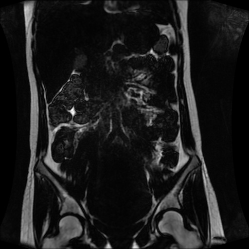 Normal MRI abdomen in pregnancy (Radiopaedia 88001-104541 N 69).jpg