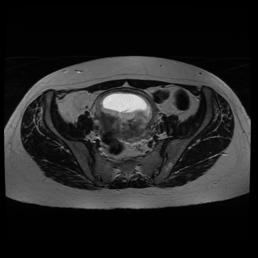Normal MRI abdomen in pregnancy (Radiopaedia 88005-104548 Axial T2 23).jpg