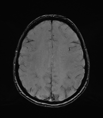 Normal brain MRI (TLE protocol) (Radiopaedia 40748-43405 Axial SWI 60).png