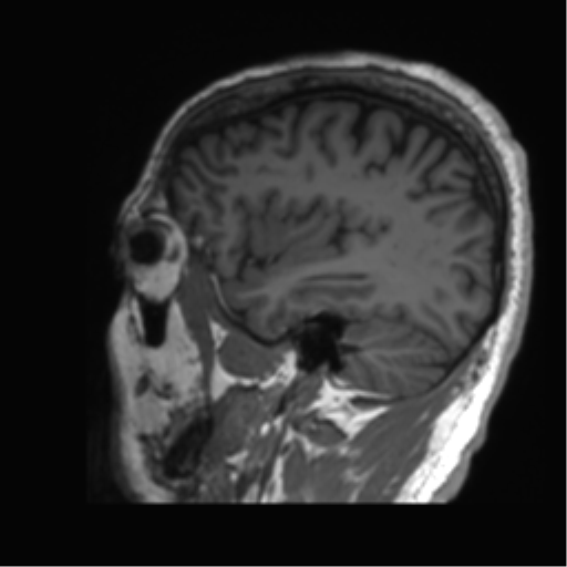 Normal brain MRI (non-focal epilepsy protocol) (Radiopaedia 53917-60040 Sagittal T1 53).png