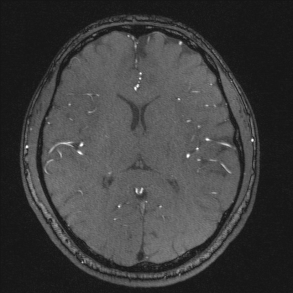 Normal brain MRI including MRA (Radiopaedia 48748-53763 Axial MRA 123).jpg