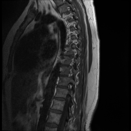 File:Normal cervical and thoracic spine MRI (Radiopaedia 35630-37156 I 4).png