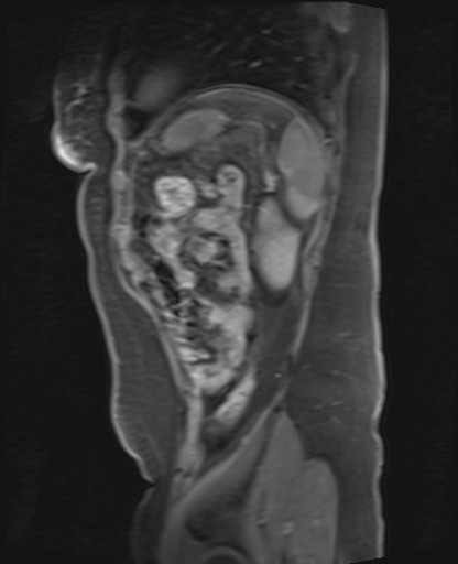 File:Normal hepatobiliary phase liver MRI (Radiopaedia 58968-66230 C 66).jpg