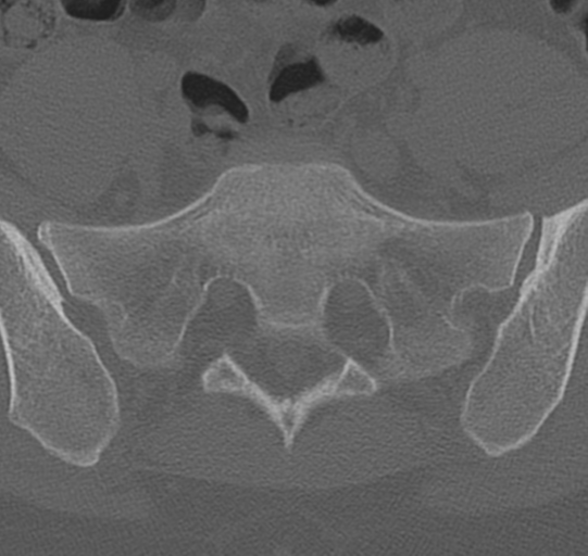 File:Normal lumbar spine CT (Radiopaedia 46533-50986 Axial bone window 70).png