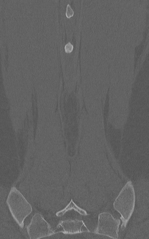 Normal lumbar spine CT (Radiopaedia 46533-50986 Coronal bone window 73).png