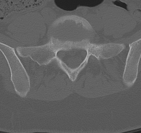 File:Normal lumbosacral CT (Radiopaedia 37923-39867 Axial bone window 80).png